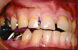 C2（象牙質まで進んだ虫歯）の治療
