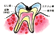 象牙質（神経に近い）の虫歯