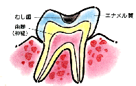 エナメル質（歯の表面）の虫歯